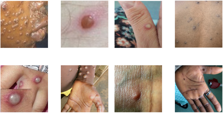 Examples of Monkeypox Rashes